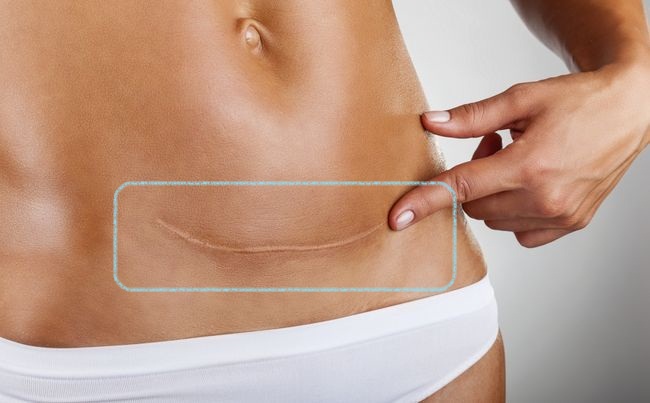 Gel topique pour les cicatrices | Revée Scar Gel – Image 13